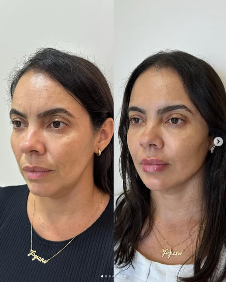Antes e depois — paciente 2